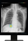 Lunit Announces Partnership to Incorporate its Chest Detection Suite into Philips' Diagnostic X-ray Suite