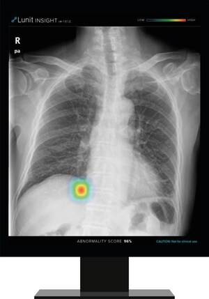 Lunit anuncia parceria para incorporar seu dispositivo de detecção de tórax ao aparelho de raio-x diagnóstico da Philips