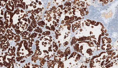 NSCLC tissue samples stained with the VENTANA ALK (D5F3) CDx Assay