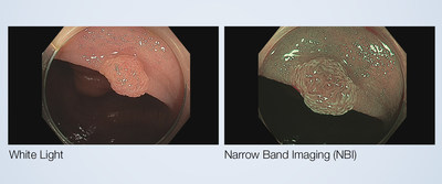 An example of a colonic lesion, or polyp, with a most likely prediction of a NICE (NBI International Colorectal Endoscopic) Type 2 adenoma as seen in near focus under the White Light and NBI (Narrow Band Imaging) observation modes of a CF-HQ190L colonovideoscope. Physicians can make high-confidence predictions of histology for polyps 5mm or smaller, known as diminutive polyps, using NBI during a screening colonoscopy for colorectal cancer.