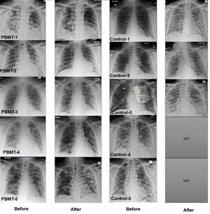 Data Published in Journal of Inflammation Research Reveal Significantly Better Outcomes in COVID-19 Pneumonia Patients Treated with MLS Laser Therapy