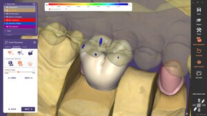 exocad Announces Roll-Out Of DentalCAD 3.0 Galway - The Productivity Booster With Instant Anatomic Morphing