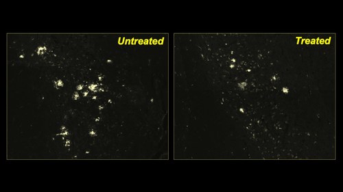 After a mouse model of Alzheimer’s was treated with the drug CA, many fewer protein clumps were present in brain neurons compared with the brain of an untreated mouse.  

Credit: Courtesy of Albert Einstein College of Medicine