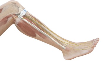 The geko™ device on the leg.