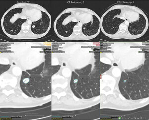 Published Research Validates HealthMyne's Radiomic Technology as a Robust Predictor of Tumor Response and Biomarker Identification