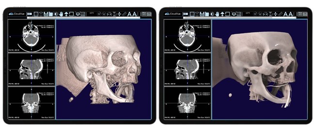 This data set was rendered on IMS CloudVue for Mobile 3D with Patented Cinematic Rendering. Both images are from the same data set and give the healthcare practitioner a 3D view and a 3D cinematic view of this patient's skull. These images are part of the team's pre-operative surgical planning, where physicians are looking for blood clots in the patient's brain vessels.