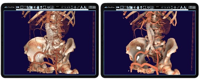 Using IMS' FDA Cleared CloudVue viewer for Mobile 3D with patented cinematic rendering, this physician can use both views to determine the procedure's efficacy. One can see the stent placement in both environments, mobile 3D and mobile 3D, with cinematic rendering. The surgical team is using these images to determine the outcome of this patient's procedure.