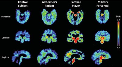 Flornaptitril binds with both tau aggregates and beta amyloid plaque to enhance PET scan imaging of these pathological proteins in the brain.