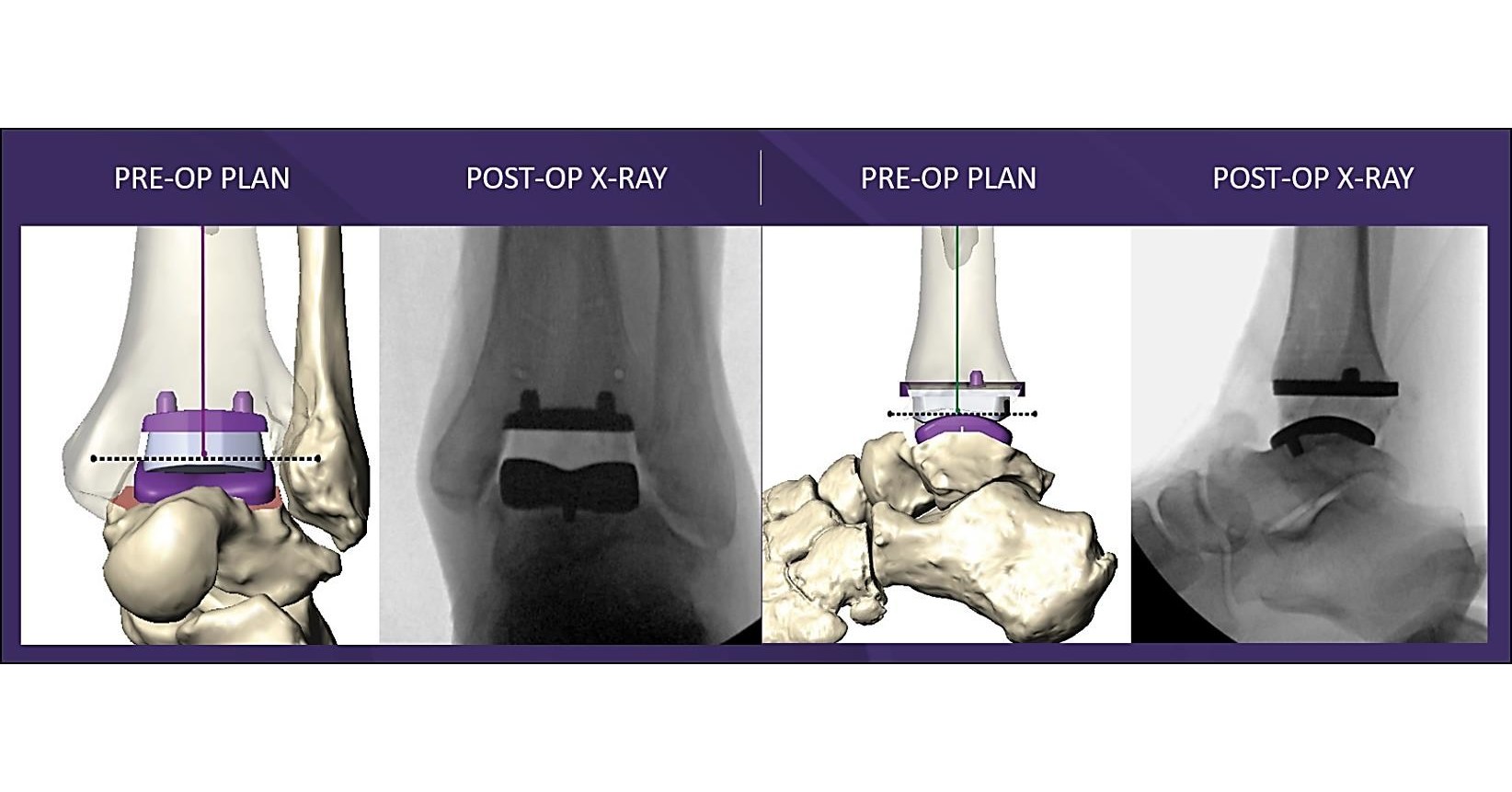Paragon 28, Inc. Receives FDA Clearance and Successfully Completes First MAVEN™ Patient-Specific Instrumentation Surgery - Vimarsana News