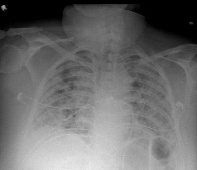 Chest X-ray from patient severely ill from COVID-19, showing (in white patches) infected tissue spread across the lungs CREDIT Courtesy of Nature Publishing or npj Digital Medicine