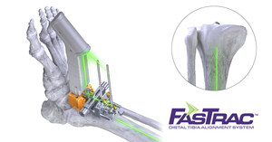 Paragon 28® Inc., Conducts the First Total Ankle Joint Replacement Surgery Utilizing Laser Alignment Technology