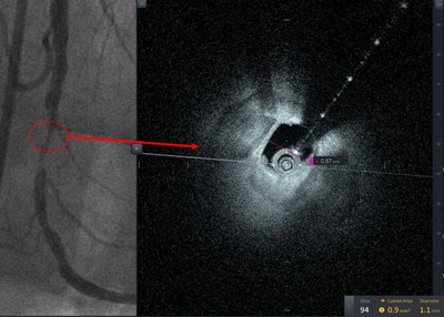 These pictures are from the first patient treated with HF-OCT, performed at Tampa General Hospital, a 1007-bed academic medical center and the primary teaching hospital for the USF Health Morsani College of Medicine. Figure 1A reveals the 90% stenosis pre-intervention. Despite this high-grade stenosis, HF-OCT was able to obtain excellent image quality.