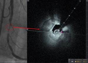 Tampa General Hospital/USF Health Interventional Cardiology Team Adopts New Intravascular Imaging Technology and Performs First Case in the World
