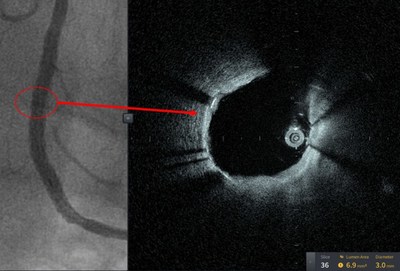 These pictures are from the first patient treated with HF-OCT, performed at Tampa General Hospital, a 1007-bed academic medical center and the primary teaching hospital for the USF Health Morsani College of Medicine. Figure 1B is after coronary stenting, confirming successful stent expansion.