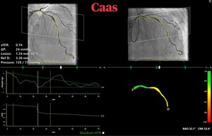 FASTII international multicenter trial confirms high diagnostic accuracy of Pie Medical Imaging CAAS vFFR solution