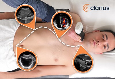 Clarius high-definition ultrasound canners enable clinicians to quickly examine the abdomen, heart, lungs, bladder, and other superficial structures.