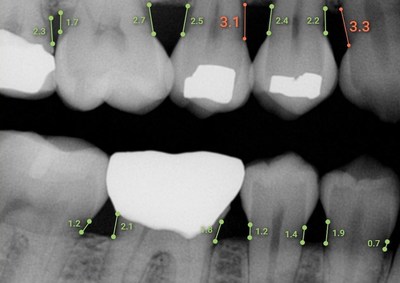 Overjet's Dental Artificial Intelligence measures bone levels in millimeters.