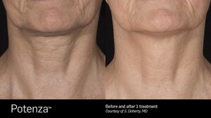 Dr. Anne Truitt and Dr. Barbara Martin Introduce Potenza RF Microneedling to San Diego