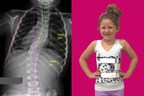 Does Your Child Have Scoliosis?