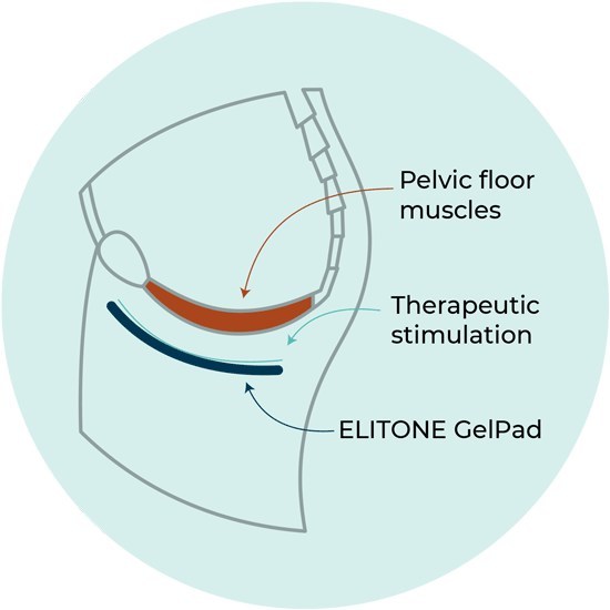ELITONE sends stimulation to contract the pelvic floor muscles.