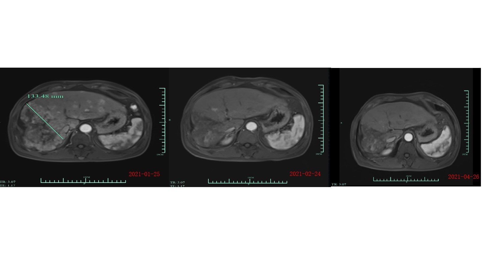 OriginCell Therapeutics Presents Positive Results of GPC3 CAR-T in HCC Trial at the 2021 ASCO Annual Meeting
