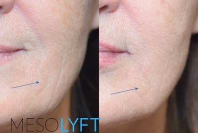 MesoLyft Derma Roller before and after