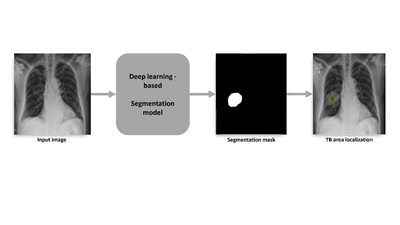 Tuberculosis Area Segmentation Approach