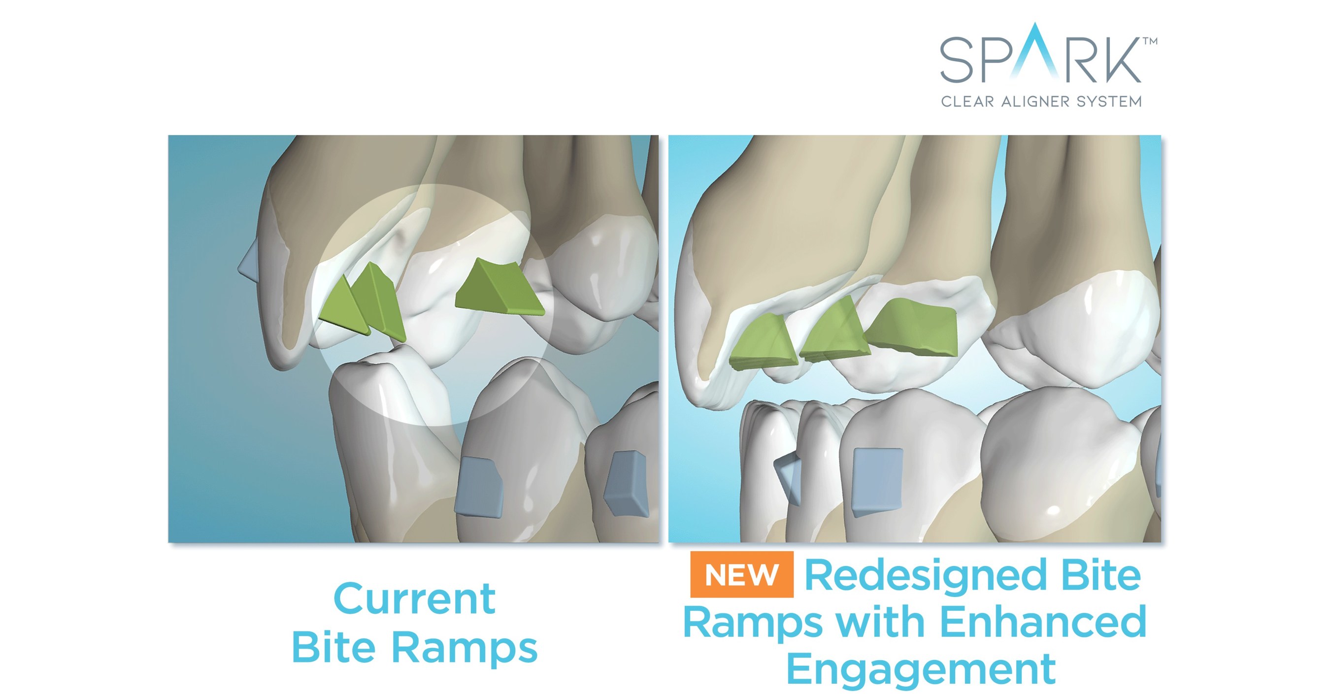 Spark Aligners Does It Again With Market Leading Innovation And New FDA ...