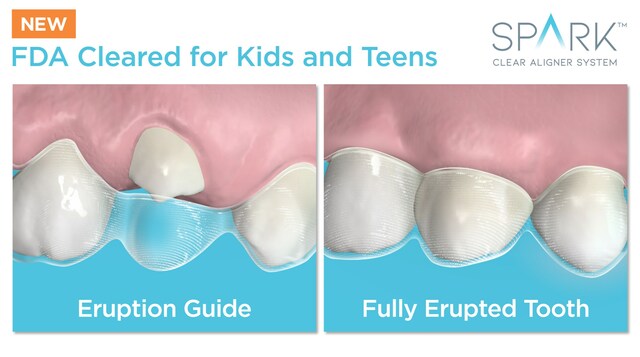 Spark Aligners Does It Again With Market Leading Innovation And New FDA 