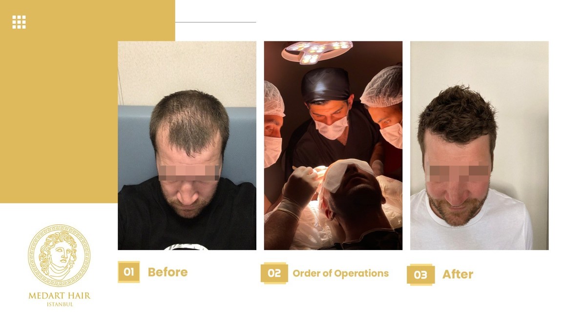 Hair Transplant Turkey in 2021 Video Results HLC