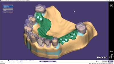 PartialCAD 3.0 Galway with new and advanced features to design high-quality removable partial dentures is now available. This new release offers a smooth integration with exocad’s DentalCAD and enhances the digital CAD/CAM possibilities for exocad users and dental technicians, providing simpler solutions to complex cases.