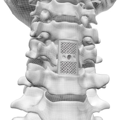 The CoreLink F3D Corpectomy Vertebral Body Replacement System features a single-piece construct to replace damaged vertebral bodies in the cervical and thoracolumbar spine. Patented and proven 3D printed Mimetic Metal® technology is incorporated into the device to emulate key characteristics of natural bone.