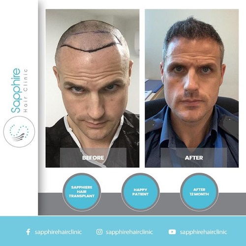 Difference: Exclusive Hair Transplant clinics vs Complete cosmetic care  clinics