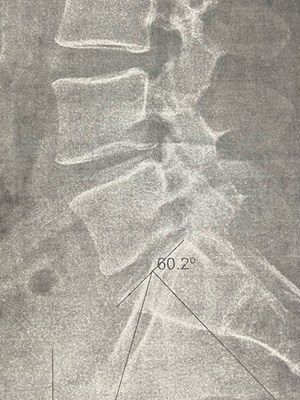 Preoperative lateral x-ray - first two-level lumbar disc replacement in DC Metro/Virginia/and Maryland [BEFORE]