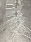 First Two-Level Lumbar Disc Replacement Performed In Metro DC, Maryland, And Virginia By Spine Surgeon Dr. Christopher Good