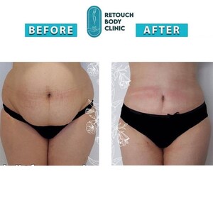 Plastic Surgery In Turkey: Retouch Body Clinic Offers Packages to Patients Worldwide