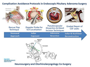 Achieving Better Outcomes in Endoscopic Pituitary Adenoma Surgery: Pacific Neuroscience Institute at Providence Saint John's Strives to Set a New Standard in Landmark 10-year Study in over 500 Patients
