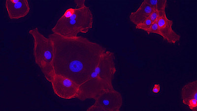 Among non-small cell lung tumors, 15% are composed of mostly EGFR-sensitive cells, which can be killed with EGFR inhibitor treatments. The nuclei of these EFGR-sensitive cells are stained in blue and the cell surfaces in red. Image: Sordella lab/CSHL, 2021