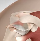 Stryker announces the FDA clearance of the first biodegradable subacromial balloon spacer, filling a gap in the shoulder continuum of care