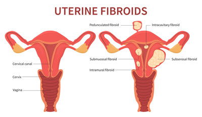 Over 20 million women between the ages of 15 and 50 have uterine fibroids. Minimally invasive procedures relieve women of pelvic pain, urinary frequency, heavy menstruation, while still preserving their fertility.