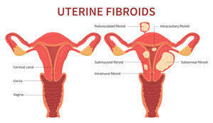 Over 26 Million Women Have Uterine Fibroids