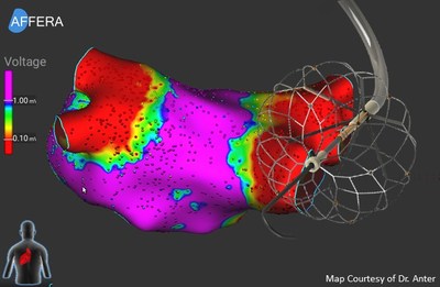 Affera SpherePVI System. Map courtesy of Dr. Anter.