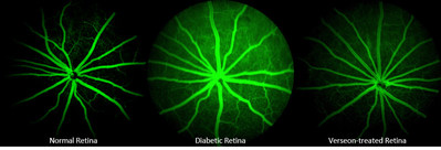 Verseon's drug candidates inhibit retinal vascular deterioration in animal models. (Courtesy: Verseon)
