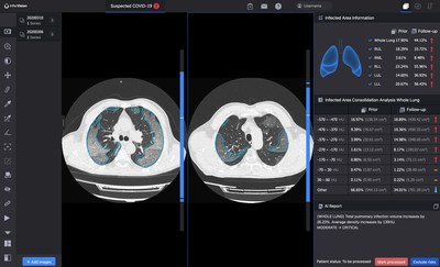 lnferRead CT Pneumonia™ compara el progreso de la infección y cuantifica los cambios a lo largo del tiempo (PRNewsfoto/InferVision AI)