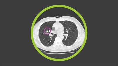 A lung nodule marked and scored in the Optellum Virtual Nodule Clinic platform.