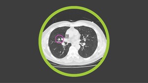 Optellum Announces Strategic Collaboration With The Lung Cancer Initiative At Johnson &amp; Johnson, Applying AI To Transform Early Lung Cancer Treatment