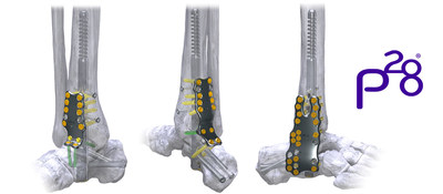 Silverback(TM) Straddle Plating System - Anterior TT, Posterior TTC, and Lateral TTC Plates