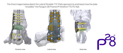 Silverback(TM) Straddle Plating System - Lateral TTC Plate