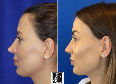 Dr Jay Calvert Revision Rhinoplasty with rib cartilage graft. Patient had three previous rhinoplasty operations that left her with a nasal tip deformity. Dr Calvert repaired this with an open technique using the patient's own rib cartilage and fascia graft.