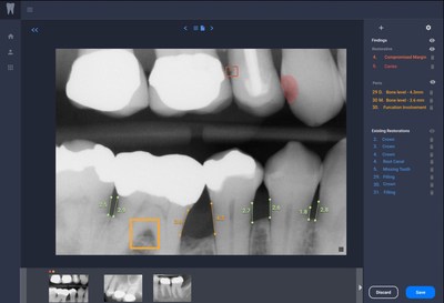 Figure: Overjet's Clinical Intelligence Platform displays a radiograph with dental artificial intelligence findings.